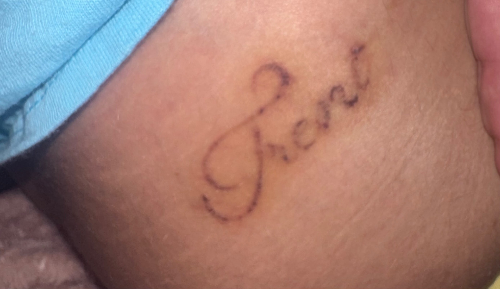 Name tattoo breaking up after laser sessions