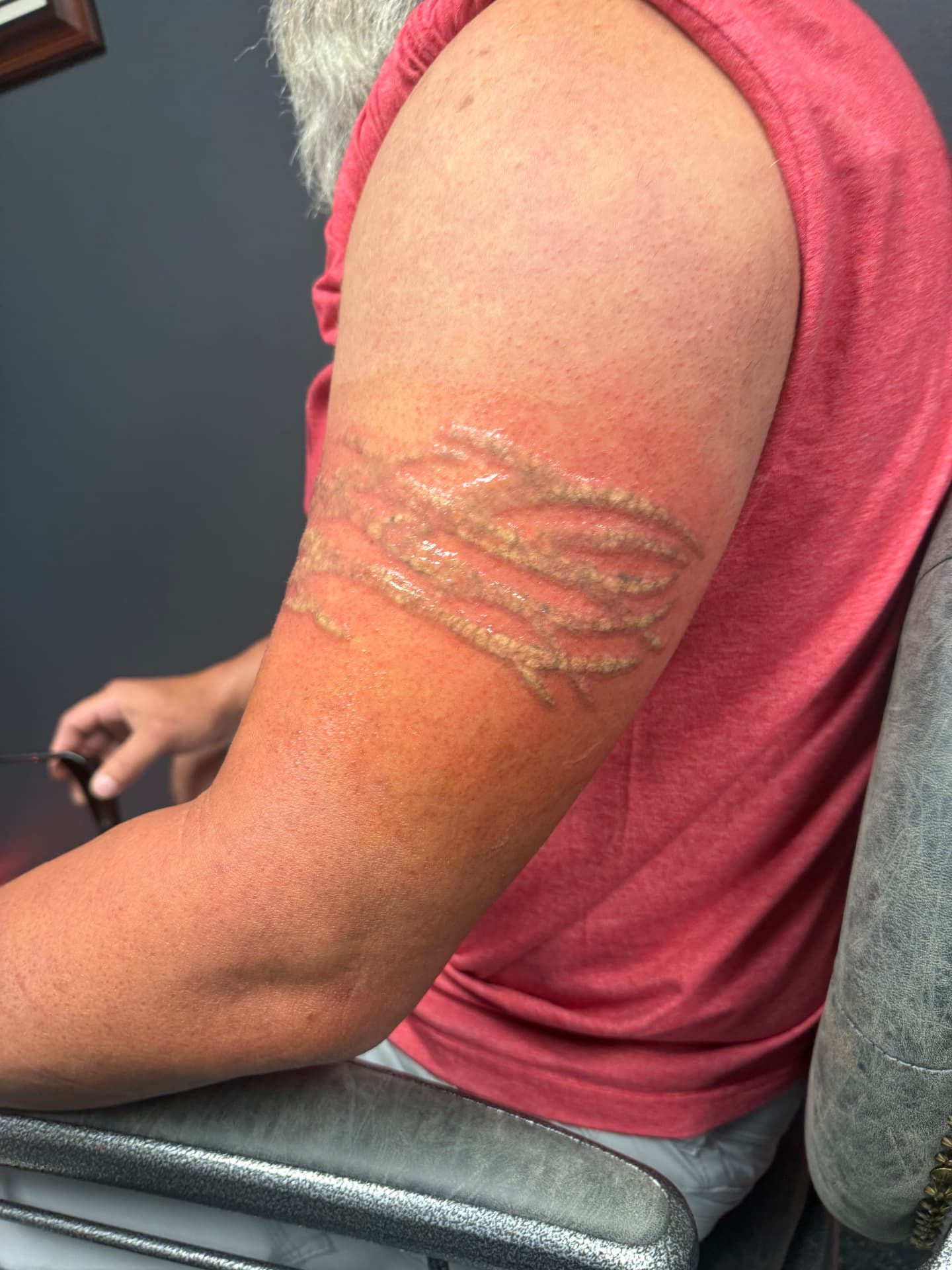 Tribal armband tattoo frosting immediately after laser treatment